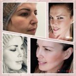 Before and after revision rhinoplasty results at CE International Hospital, improved nose shape