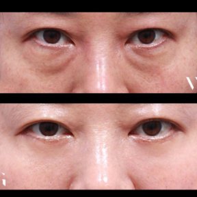Vorher-nachher-Blepharoplastik bei VG Plastic Surgery, glatteres Lidkorrektur-Ergebnis