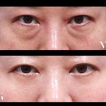 Vorher-nachher-Blepharoplastik bei VG Plastic Surgery, glatteres Lidkorrektur-Ergebnis