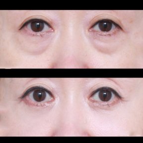 Vorher-nachher-Ergebnis der Blepharoplastik bei VG Plastic Surgery, Lidkorrektur