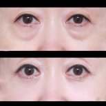 Vorher-nachher-Ergebnis der Blepharoplastik bei VG Plastic Surgery, Lidkorrektur