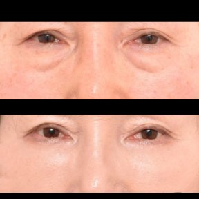 Vorher-nachher-Ergebnis der Blepharoplastik bei VG Plastic Surgery, Lidkorrektur