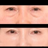 Vorher-nachher-Ergebnis der Blepharoplastik bei VG Plastic Surgery, Lidkorrektur