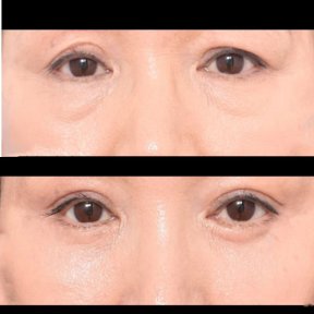 Vorher-nachher-Ergebnis der Blepharoplastik bei VG Plastic Surgery, Lidkorrektur