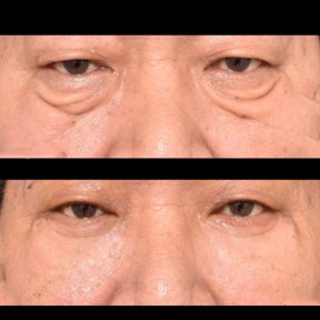 Vorher-nachher-Ergebnis Blepharoplastik bei VG Plastic Surgery, weniger Augenringe