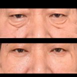 Vorher-nachher-Ergebnis Blepharoplastik bei VG Plastic Surgery, weniger Augenringe