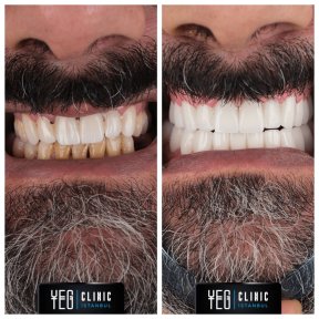 Vorher-nachher-Ergebnis Emax Veneers bei YEG Clinic – Lächeln-Transformation und weiße Zähne