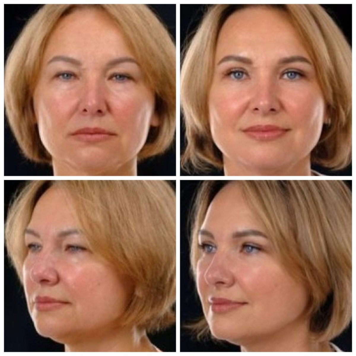 Vorher-nachher-Ergebnisse Deep Plane Facelift bei Yurchenko Plastic Surgery Team Kyiv, Gesichtsverjüngung