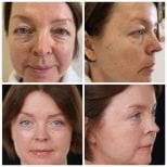 نتائج شد الوجه العميق قبل وبعد في Yurchenko Plastic Surgery Team Kyiv، تجديد شباب الوجه