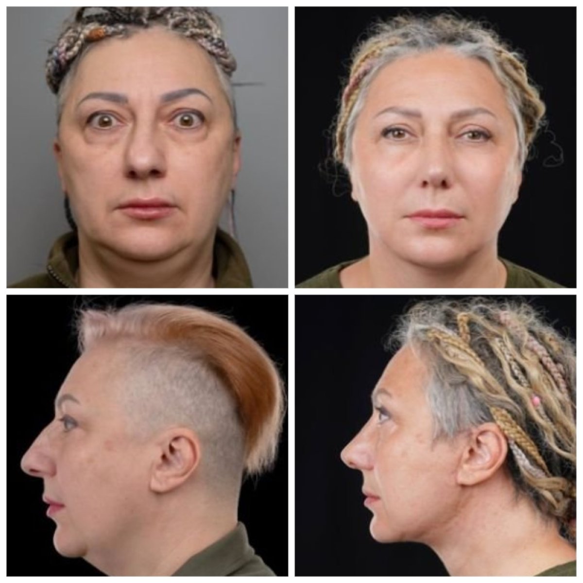 Vorher-nachher-Ergebnisse Deep Plane Facelift bei Yurchenko Plastic Surgery Team Kyiv, Gesichtsverjüngung