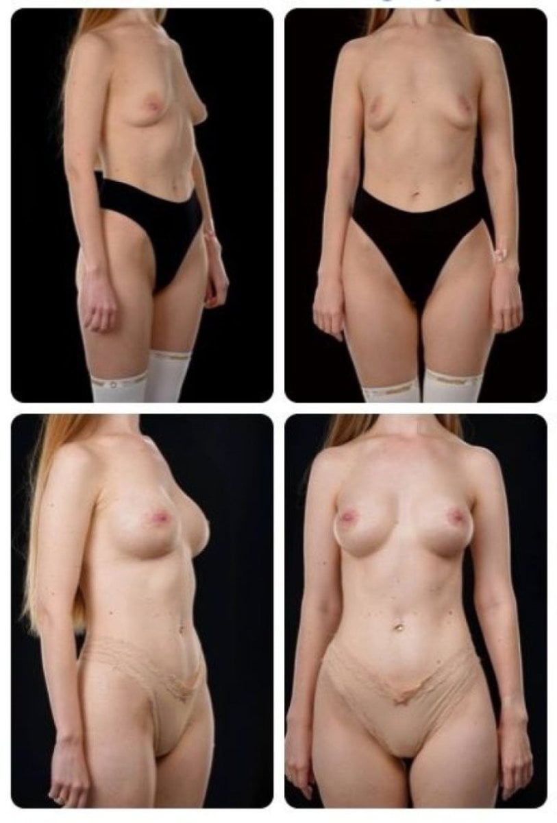 Resultados antes y después de aumento de senos en Yurchenko Plastic Surgery Team Kyiv
