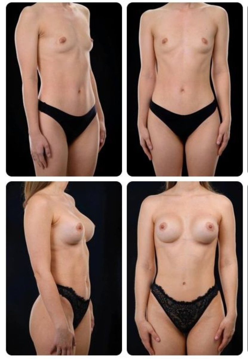 Resultados antes y después de aumento de senos en Yurchenko Plastic Surgery Team Kyiv