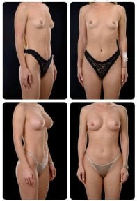 Résultats avant et après augmentation mammaire chez Yurchenko Plastic Surgery Team Kyiv