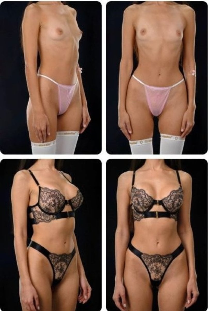 Resultados antes y después de aumento de senos en Yurchenko Plastic Surgery Team Kyiv