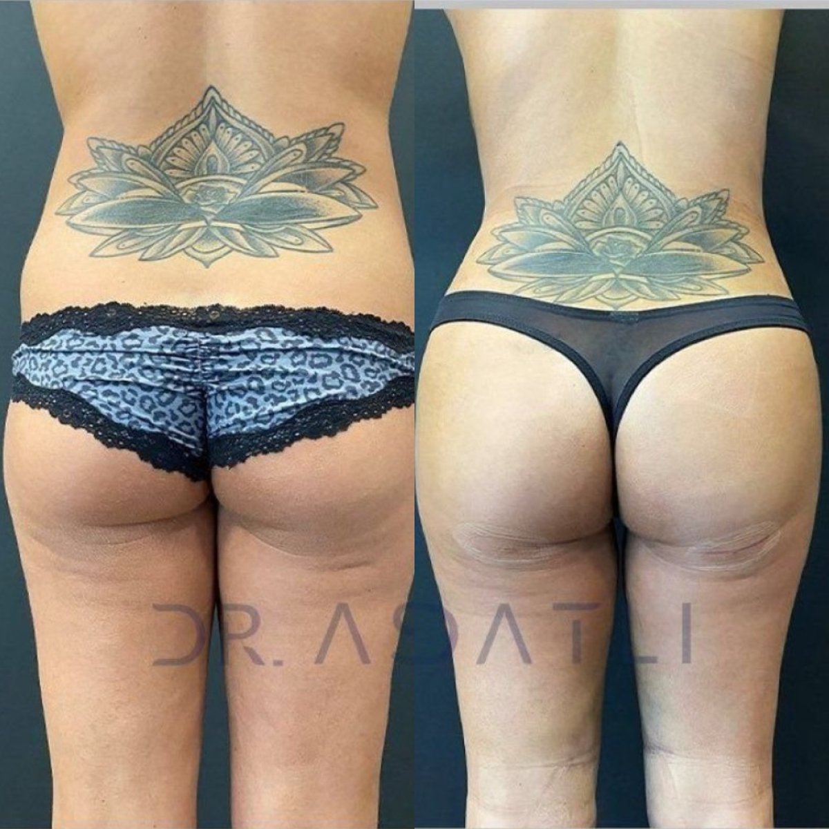 Vorher-nachher-Ergebnis Brazilian Butt Lift bei Liv Hospital Ulus, verbesserte Kontur