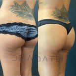 Vorher-nachher-Ergebnis Brazilian Butt Lift bei Liv Hospital Ulus, verbesserte Gesäßform