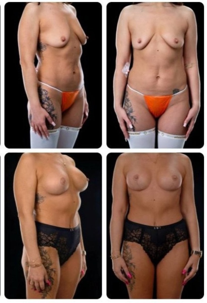 Before and after breast lift results at Yurchenko Plastic Surgery Team Kyiv, improved contour