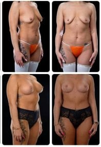 Before and after breast lift results at Yurchenko Plastic Surgery Team Kyiv, improved contour