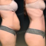Before and after tummy tuck results at Memorial Antalya Hospital, visible abdominal contouring