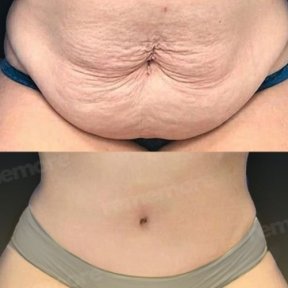 Before and after tummy tuck results at Memorial Antalya Hospital, improved abdominal contour