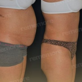 Before and after tummy tuck results at Memorial Antalya Hospital, visible abdominal contouring