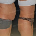 Before and after tummy tuck results at Memorial Antalya Hospital, visible abdominal contouring