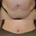 Before and after tummy tuck results at Memorial Antalya Hospital, improved abdominal contour