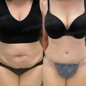 Результаты абдоминопластики до и после в Memorial Antalya Hospital, улучшенный контур живота