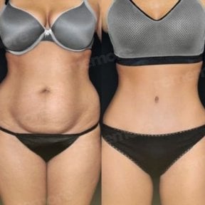 Результаты абдоминопластики до и после в Memorial Antalya Hospital, видимый контур живота