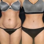 Результаты абдоминопластики до и после в Memorial Antalya Hospital, видимый контур живота