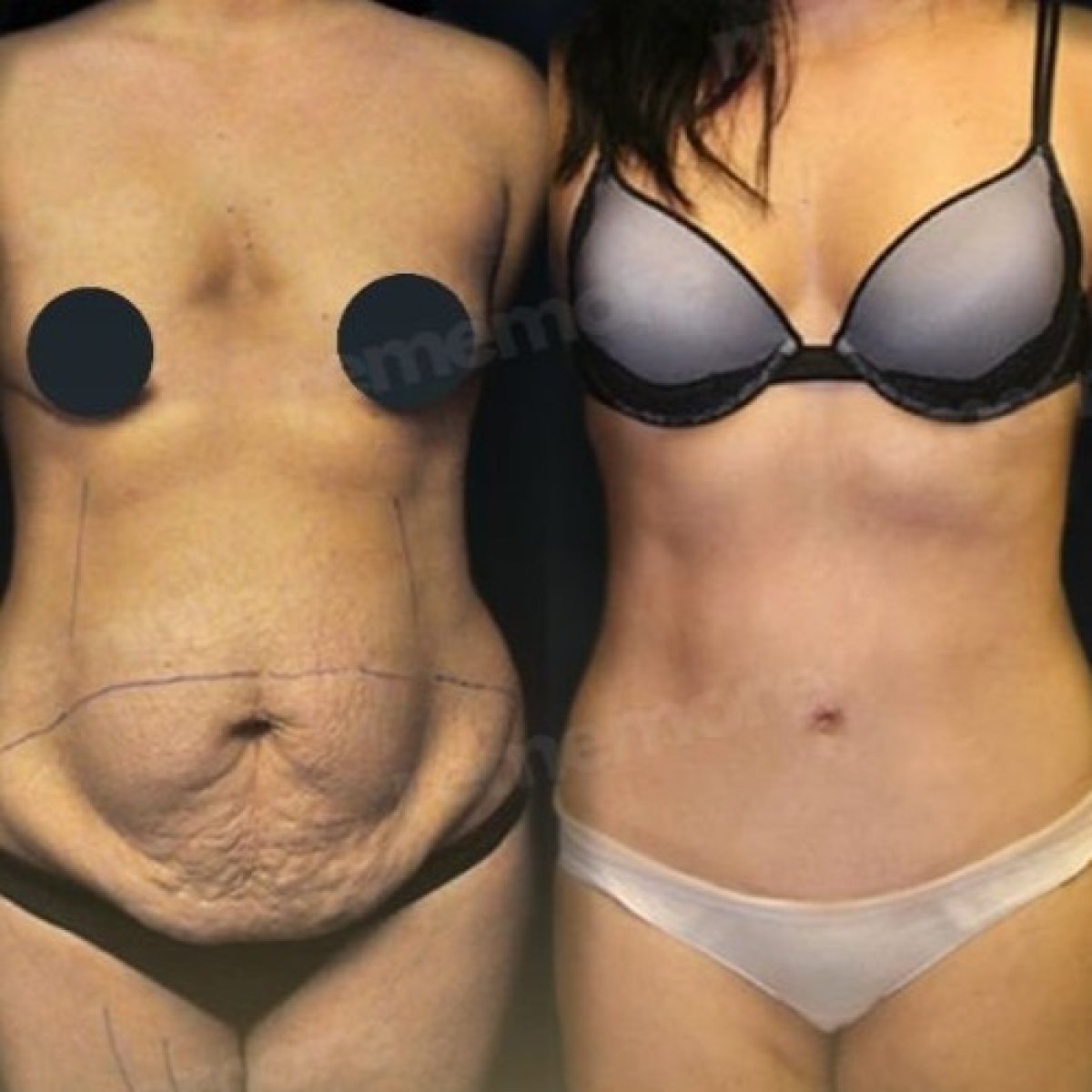 Resultados de abdominoplastia antes y después en Memorial Antalya Hospital, contorno abdominal visible
