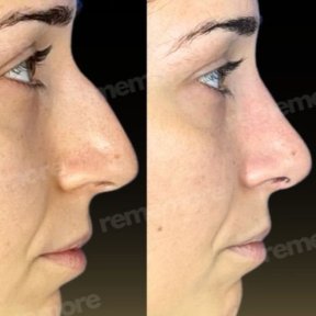 Before and after nasal hump removal at Memorial Şişli Hospital, rhinoplasty visible result