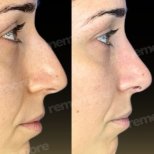 Before and after nasal hump removal at Memorial Şişli Hospital, rhinoplasty visible result