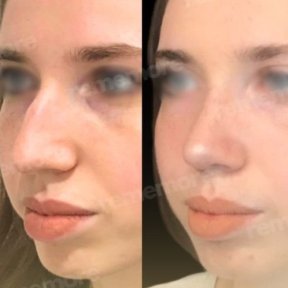 Before and after nasal hump removal at Memorial Şişli Hospital, rhinoplasty result