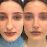 Before and after nasal hump removal results at Memorial Şişli Hospital, improved nose profile