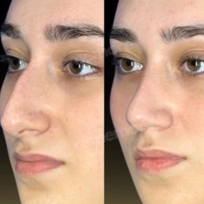 Before and after nasal hump removal at Memorial Şişli Hospital, rhinoplasty result visible