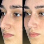 Before and after nasal hump removal at Memorial Şişli Hospital, rhinoplasty result visible