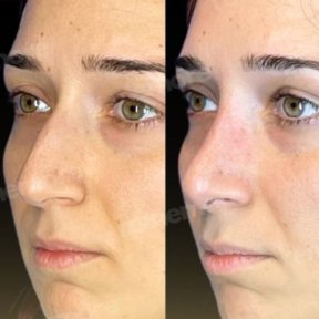 Before and after nasal hump removal at Memorial Şişli Hospital, rhinoplasty result visible