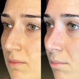 Before and after nasal hump removal at Memorial Şişli Hospital, rhinoplasty result visible