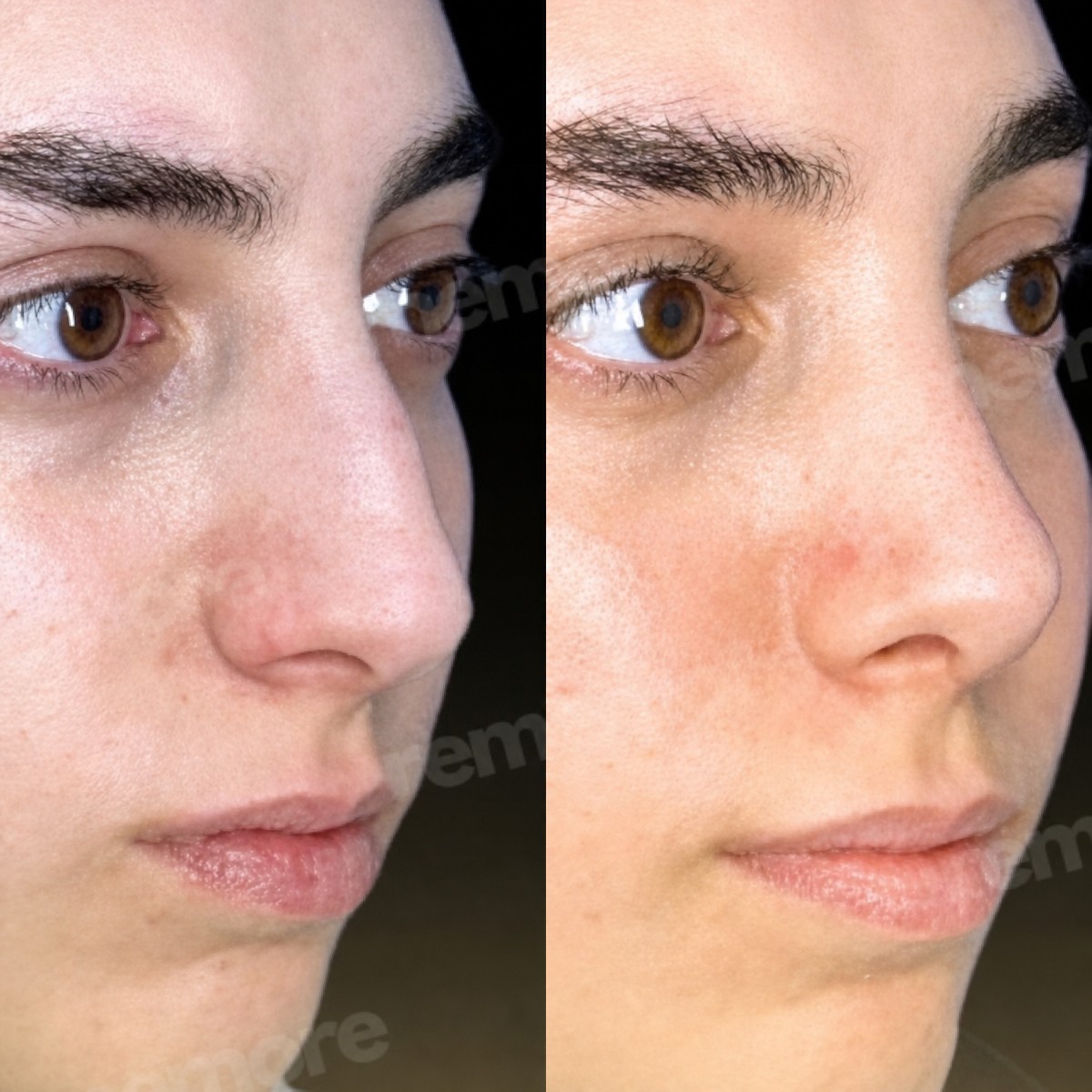 قبل وبعد إزالة حدبة الأنف في مستشفى ميموريال شيشلي، نتيجة تجميل الأنف واضحة