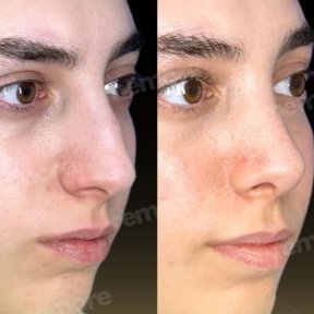 Before and after nasal hump removal at Memorial Şişli Hospital, rhinoplasty result visible