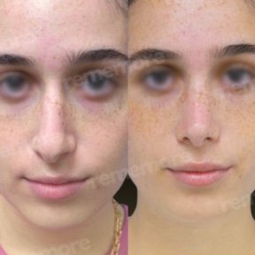 Before and after nasal hump removal at Memorial Şişli Hospital, rhinoplasty result visible