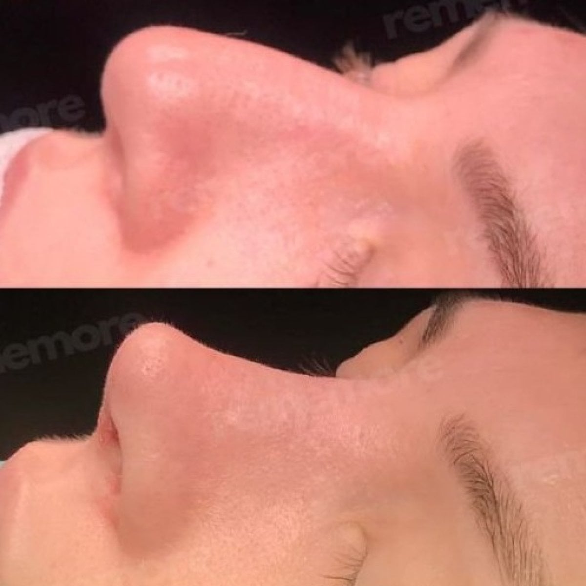 Antes y después de eliminación de giba nasal en Memorial Şişli Hospital, resultado de rinoplastia