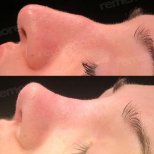 Before and after nasal hump removal results at Memorial Şişli Hospital, smoother nose profile