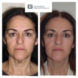Результат до і після ін'єкцій філерів у Clinica Granado Tiagonce, омолодження обличчя