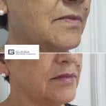 До та після ін'єкцій філерів у Clinica Granado Tiagonce, результат омолодження обличчя