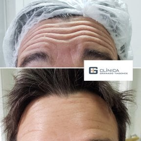 До та після ін'єкцій філерів у Clinica Granado Tiagonce, результат зменшення зморшок на лобі
