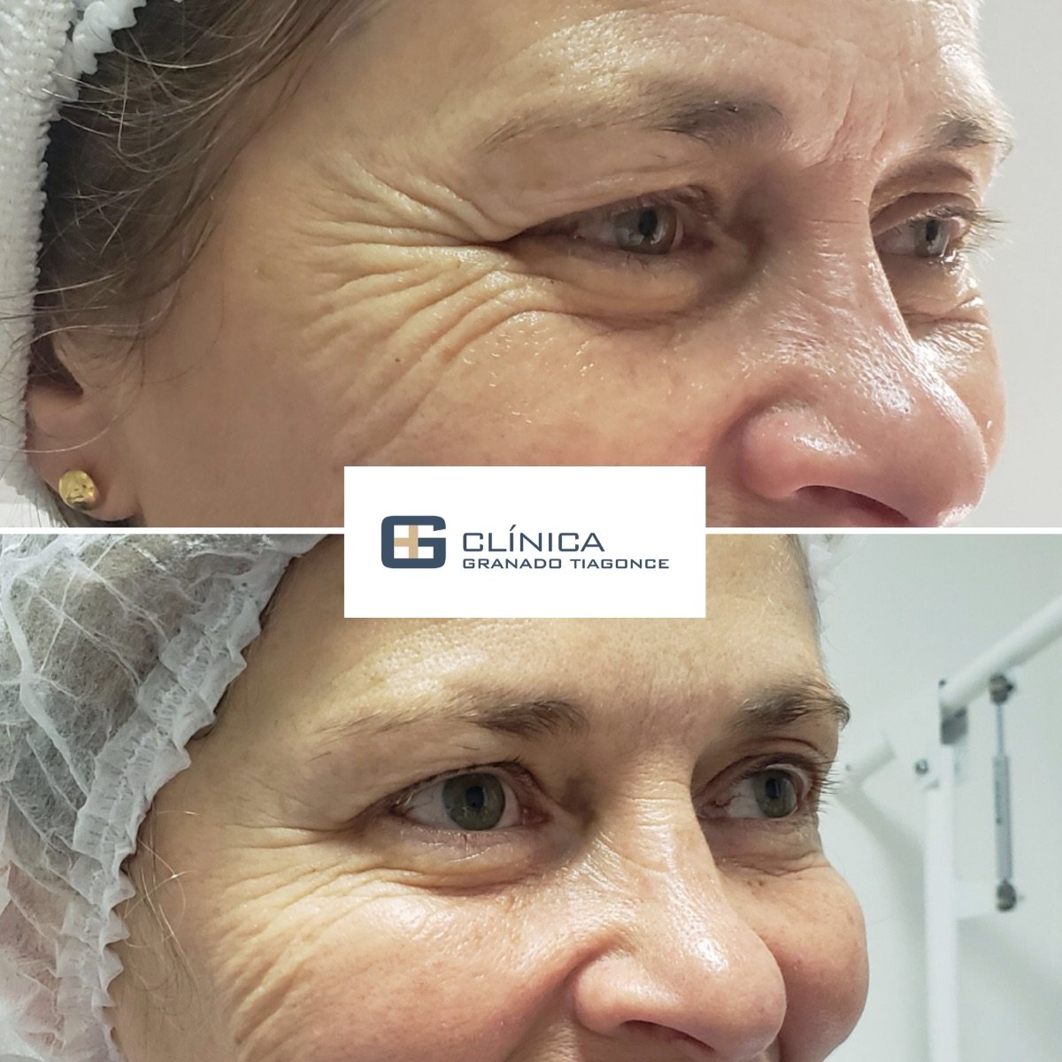 Resultados antes y después de rellenos en Clinica Granado Tiagonce, reducción de arrugas