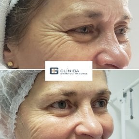 Результат до та після ін'єкцій філерів у Clinica Granado Tiagonce, зменшення зморшок