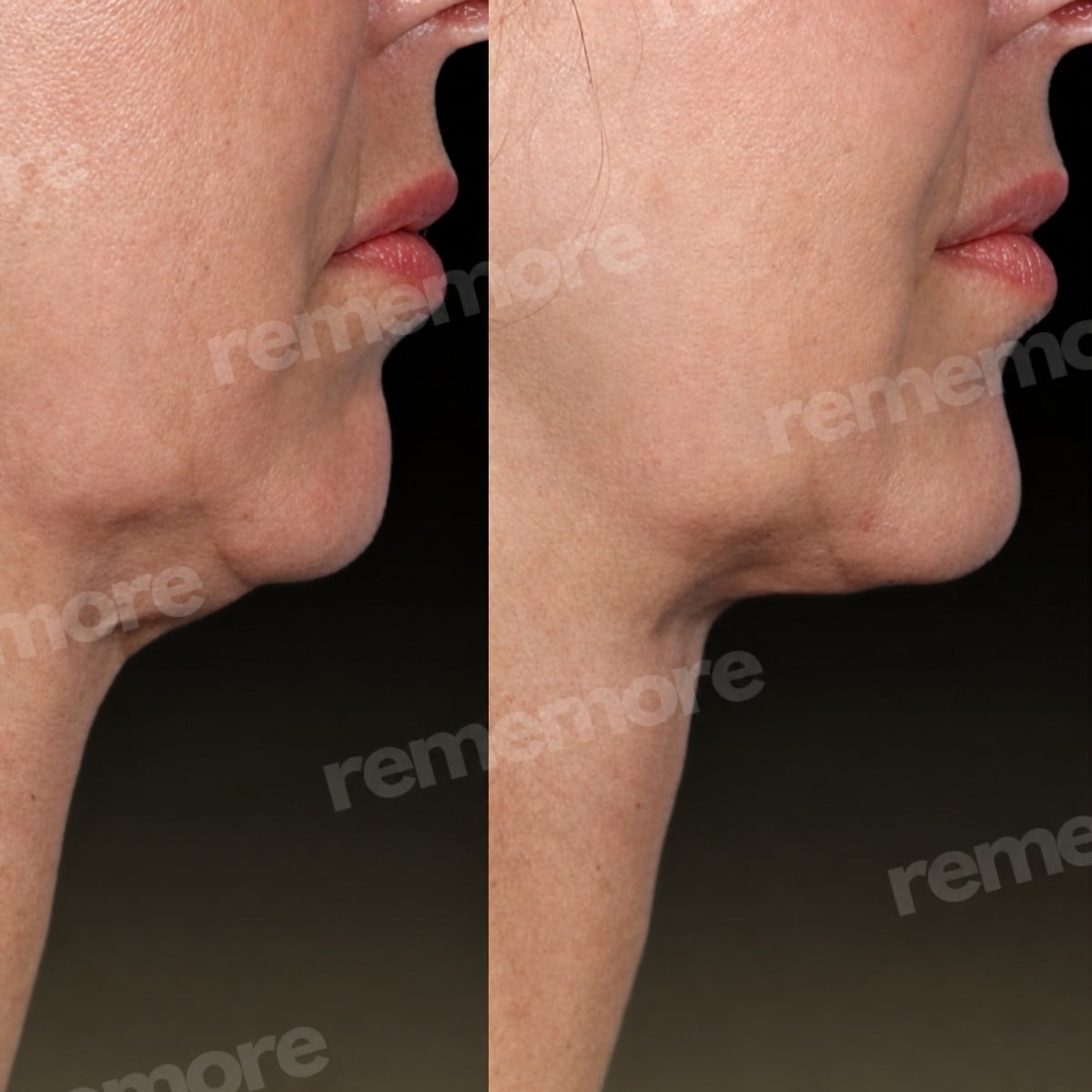 Resultados de feminización facial antes y después en Memorial Şişli Hospital, contorno mandibular